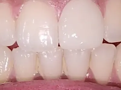 After: the front teeth restored and the gap closed