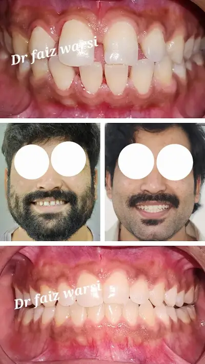 Smile result by Dr. Faiz Warsi