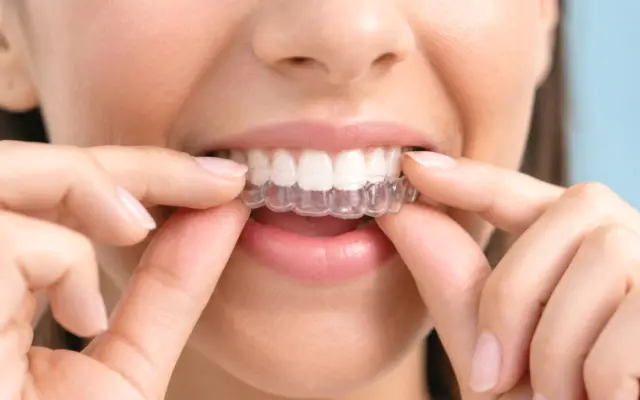Woman placing a clear aligner over her teeth